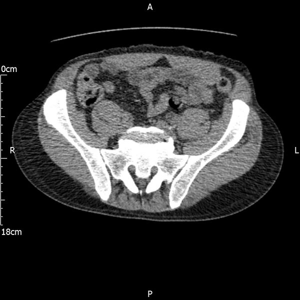 File:Bilateral medullary nephrocalcinosis with ureteric calculi (Radiopaedia 71269-81569 Axial non-contrast 96).jpg