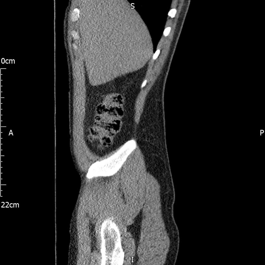 Bilateral medullary nephrocalcinosis with ureteric calculi (Radiopaedia 71269-81569 C 95).jpg