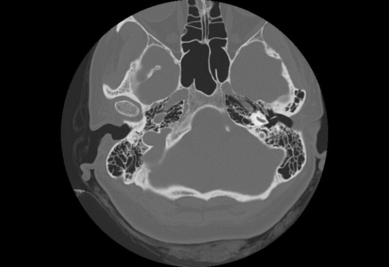 File:Bilateral otospongiosis (Radiopaedia 35447-36940 B 19).jpg
