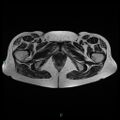 Bilateral ovarian fibroma (Radiopaedia 44568-48293 Axial T2 28).jpg
