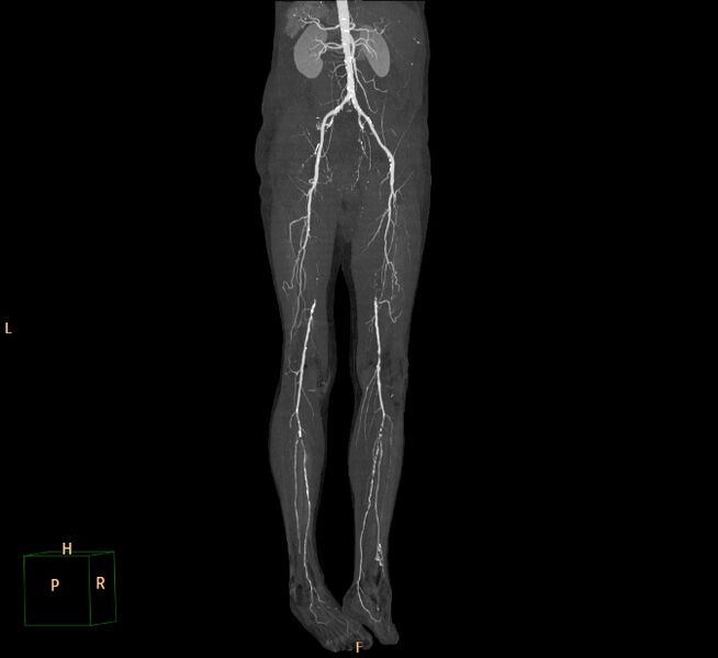 File:Bilateral superficial femoral arterial occlusion (Radiopaedia 25682-25857 3D MIP 12).jpg