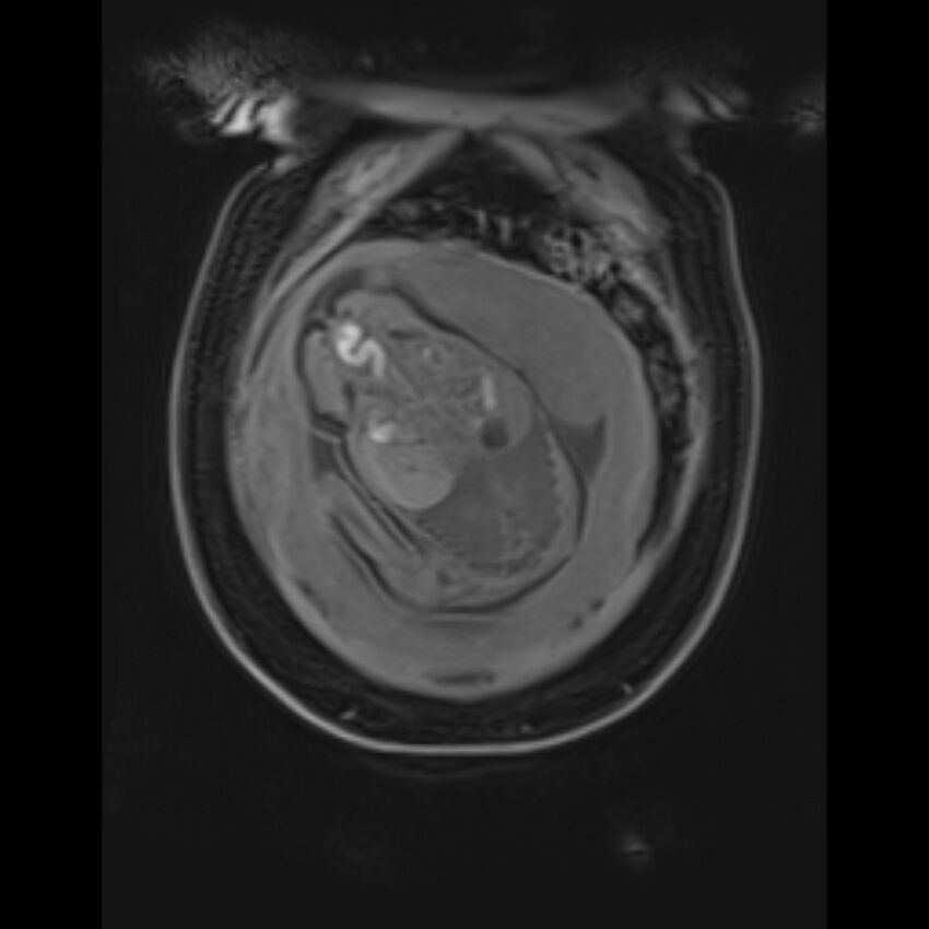 Bilobed placenta accreta (Radiopaedia 69648-79591 Coronal T1 vibe 33).jpg