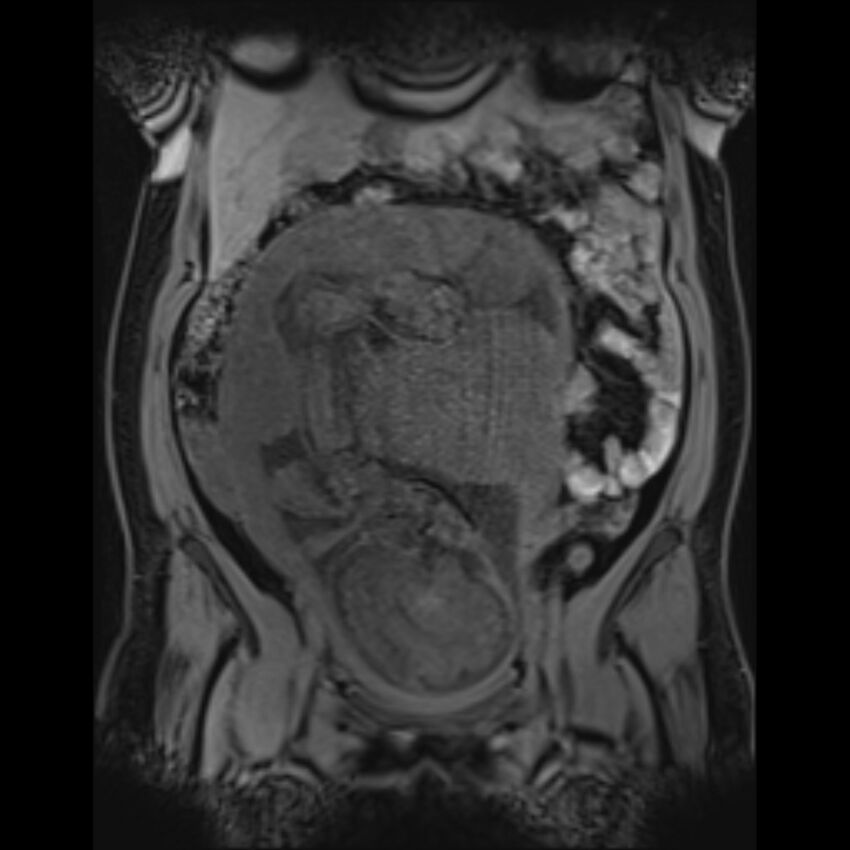 Bilobed placenta accreta (Radiopaedia 69648-79591 Coronal T1 vibe 78).jpg