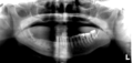 Bisphosphonate-related osteonecrosis of the jaw (BRONJ) (Radiopaedia 43741).PNG