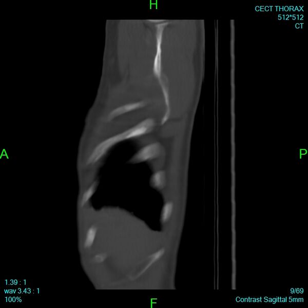File:Bone metastases from lung carcinoma (Radiopaedia 54703-60937 Sagittal bone window 9).jpg