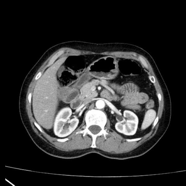 File:Bosniak renal cyst - type I (Radiopaedia 27479-27675 renal cortical phase 27).jpg
