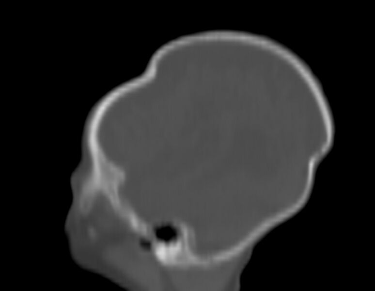 File:Brachycephaly (bi-coronal and bi-lambdoid synostosis) (Radiopaedia 55048-61413 Sagittal bone window 24).jpg