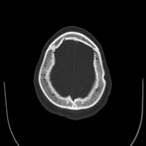 File:Brain Pantopaque remnants (Radiopaedia 78403-91048 Axial bone window 60).jpg