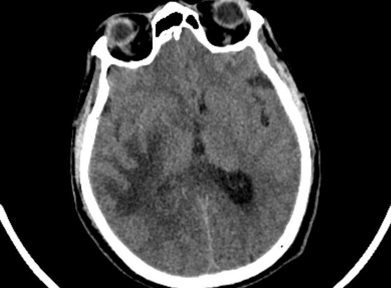 File:Brain abscess complicated by intraventricular rupture and ventriculitis (Radiopaedia 82434-96575 Axial non-contrast 44).jpg