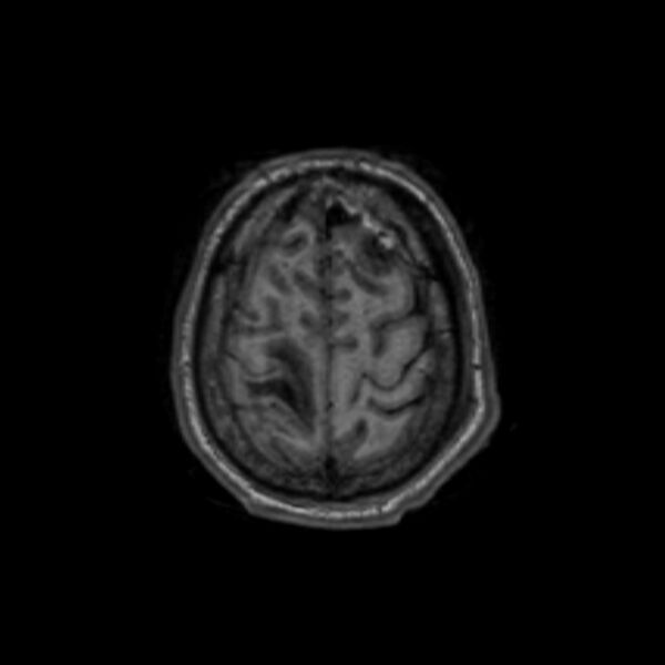 File:Brain abscess complicated by intraventricular rupture and ventriculitis (Radiopaedia 82434-96577 Axial T1 62).jpg