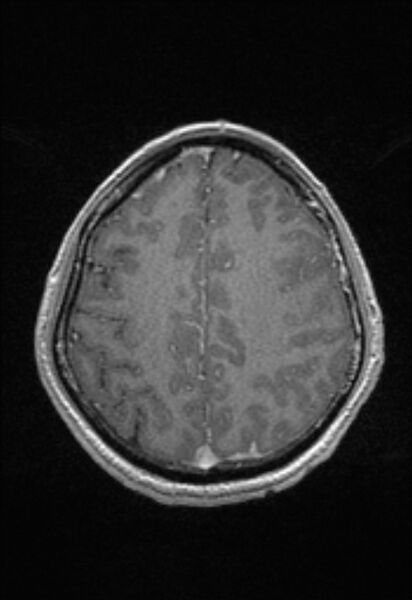 File:Brain abscess with ventriculitis (Radiopaedia 85703-101495 Axial T1 C+ 130).jpg