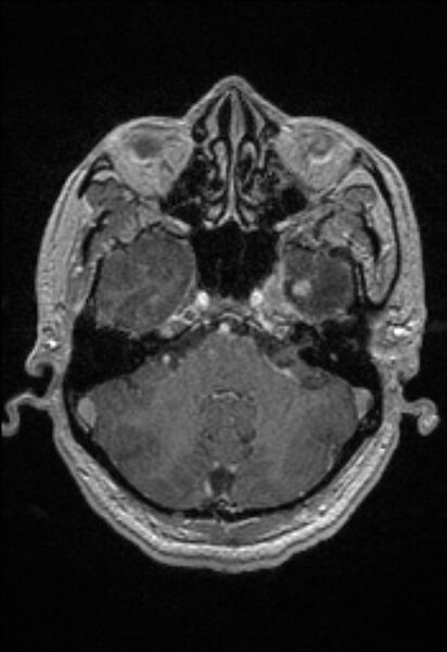File:Brain abscess with ventriculitis (Radiopaedia 85703-101495 Axial T1 C+ 48).jpg
