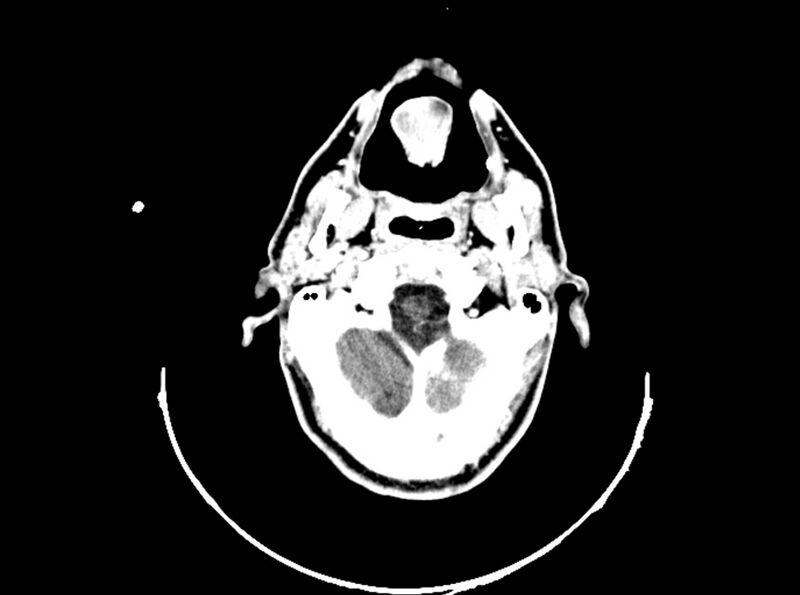 File:Brain injury by firearm projectile (Radiopaedia 82068-96088 B 62).jpg