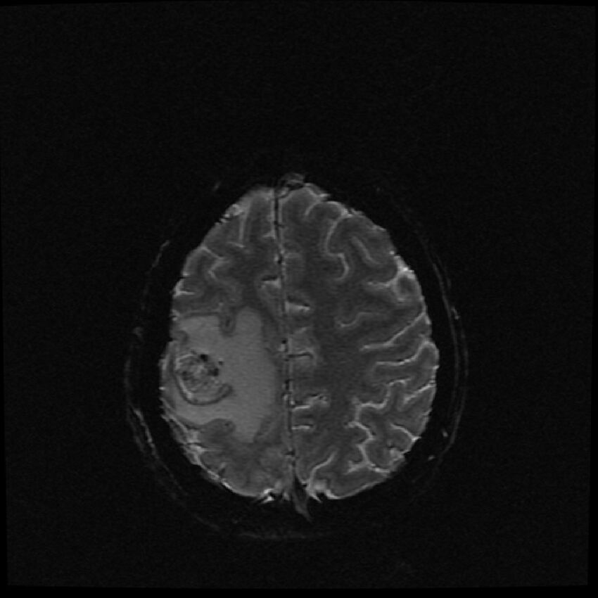 Brain metastases (renal cell carcinoma) (Radiopaedia 42571-45704 Axial SWI 9).jpg