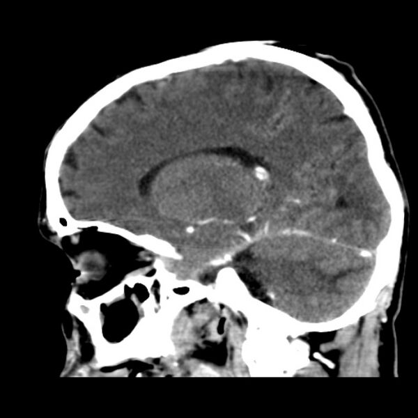 File:Brain metastases from lung cancer (Radiopaedia 24480-24781 C+ delayed 23).jpg