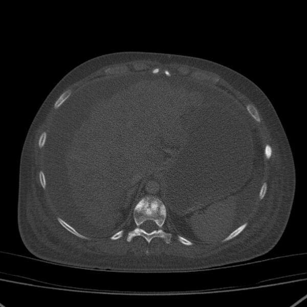 File:Breast cancer metastases - hepatic and skeletal (Radiopaedia 34201-35461 Axial bone window 39).jpg