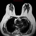 Breast carcinoma (multicentric multifocal in mammary Paget disease) (Radiopaedia 50966-56512 Axial T2 9).jpg