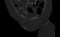 Breast carcinoma with pathological hip fracture (Radiopaedia 60314-67993 Coronal bone window 36).jpg