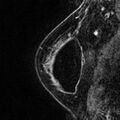 Breast implants - MRI (Radiopaedia 26864-27035 Sagittal T2 14).jpg