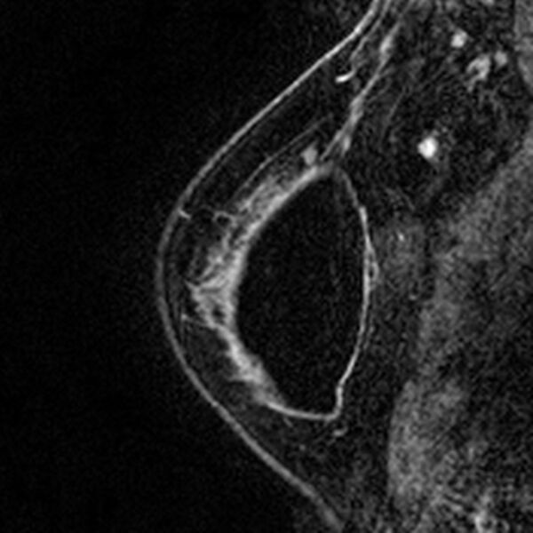 File:Breast implants - MRI (Radiopaedia 26864-27035 Sagittal T2 14).jpg