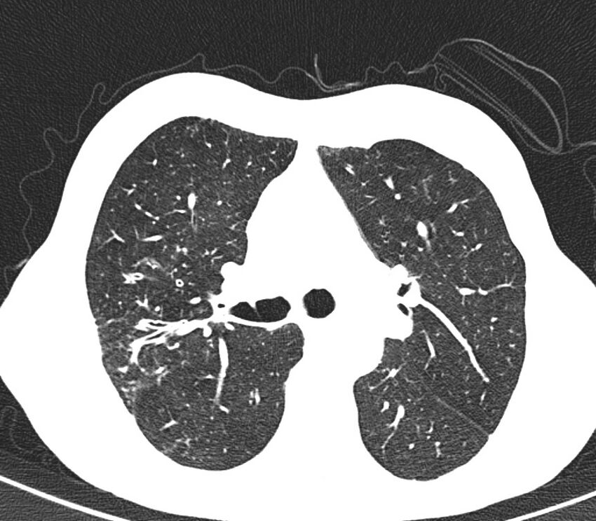 Bronchiolitis (Radiopaedia 24616-24887 Axial lung window 21).jpg