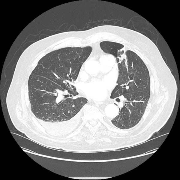 File:Bronchogenic adenocarcinoma and pulmonary embolism (Radiopaedia 9097-9806 Axial lung window 16).jpg