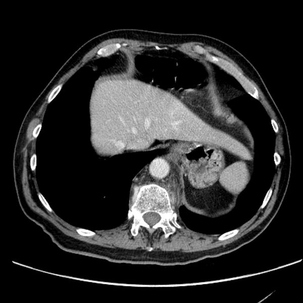 File:Bronchogenic carcinoma with L1 vertebra metastasis (Radiopaedia 9096-9805 Axial C+ delayed 29).jpg