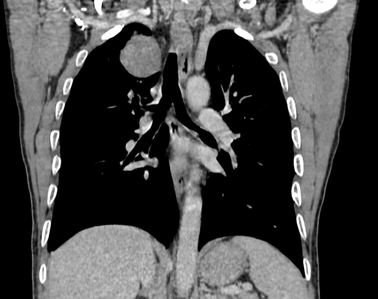 File:Bronchogenic carcinoma with superior vena cava syndrome (Radiopaedia 36497-38054 Coronal C+ delayed 60).jpg