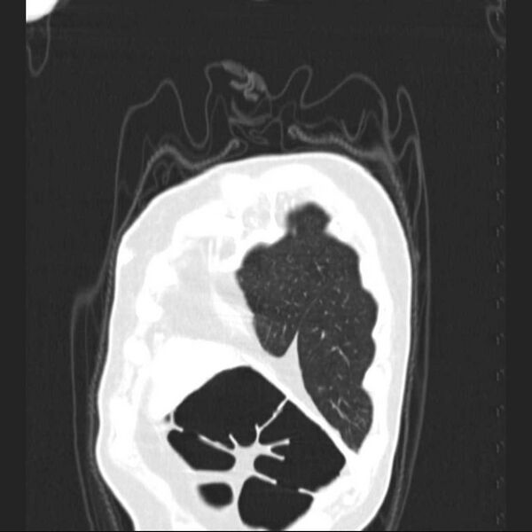 File:Bronchopleural fistula - postoperative complication (Radiopaedia 21020-20947 Coronal lung window 3).jpg