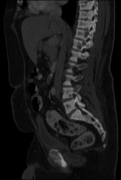 File:Brown tumors compressing the spinal cord (Radiopaedia 68442-77988 H 27).jpg