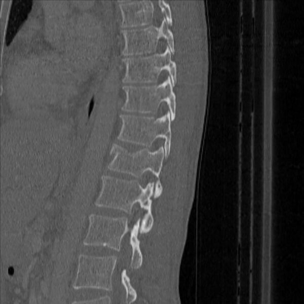 File:Bulging of paraspinal line in traumatic thoracal spinal compression fracture (Radiopaedia 29221-35872 Sagittal bone window 36).jpg