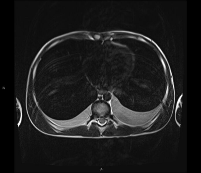 File:Burkitt lymphoma (bowel) (Radiopaedia 68839-78557 Axial T2 3).jpg