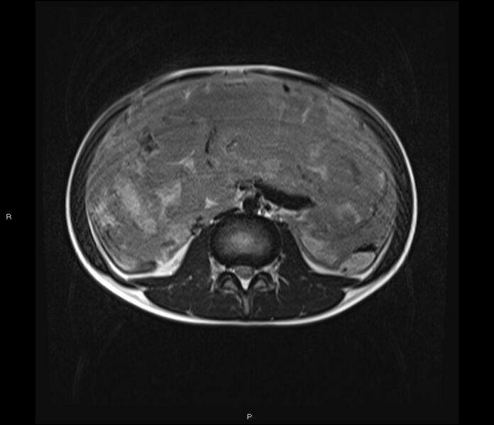File:Burkitt lymphoma (bowel) (Radiopaedia 68839-78557 Axial T2 34).jpg