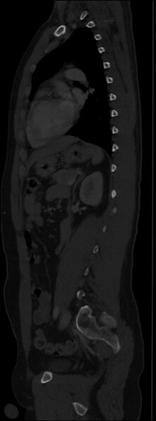 File:Burst fracture (Radiopaedia 83168-97542 Sagittal bone window 80).jpg