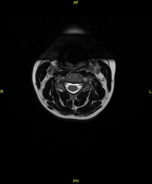 File:C5 nerve sheath tumor (Radiopaedia 85777-101596 Axial T2 16).jpg