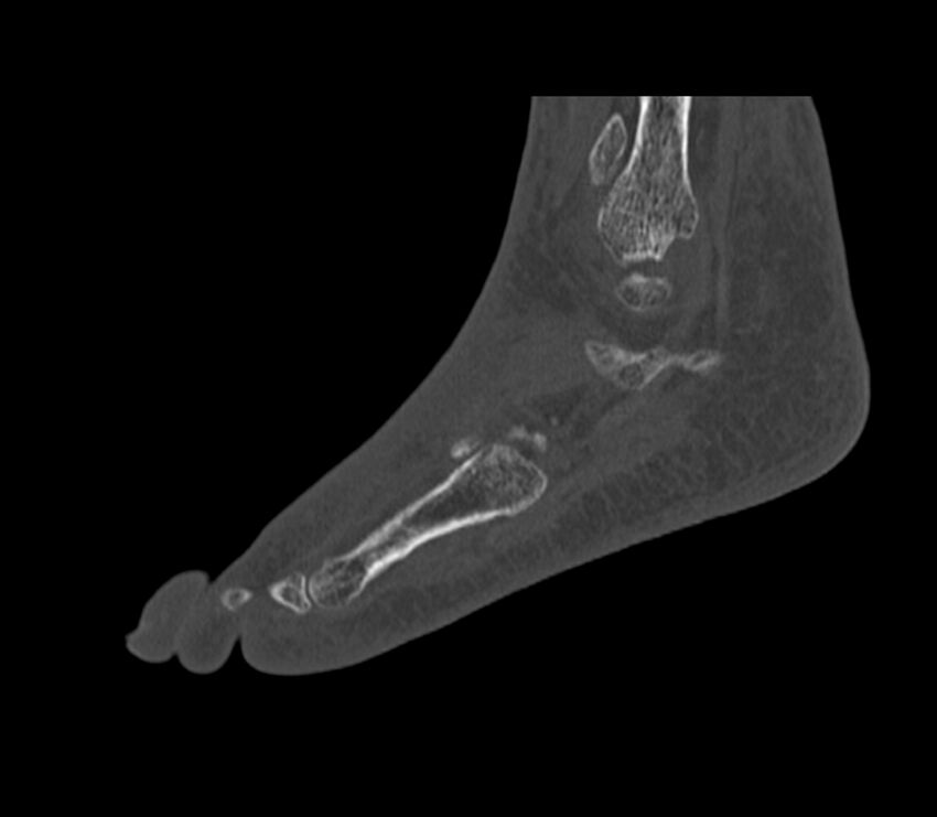 Calcaneal tuberosity avulsion fracture (Radiopaedia 22649-22668 Sagittal bone window 10).jpg