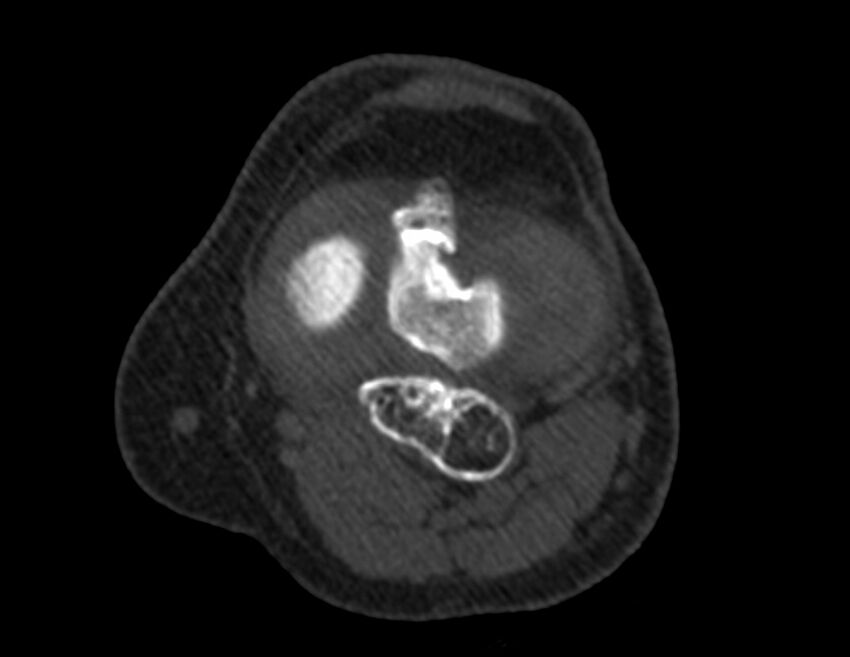 Calcified hematoma - popliteal fossa (Radiopaedia 63938-72763 Axial bone window 25).jpg
