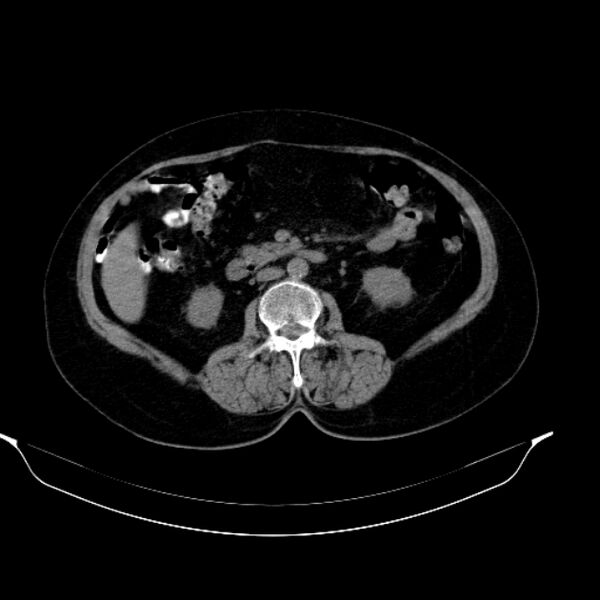 File:Calcified hydatid cyst (Radiopaedia 62000-70085 Axial non-contrast 53).jpg