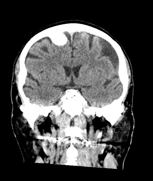 File:Calcified meningioma (Radiopaedia 74361-85243 Coronal non-contrast 23).jpg