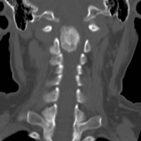 File:Calcified meningioma - cervical canal (Radiopaedia 70136-80171 Coronal bone window 17).jpg