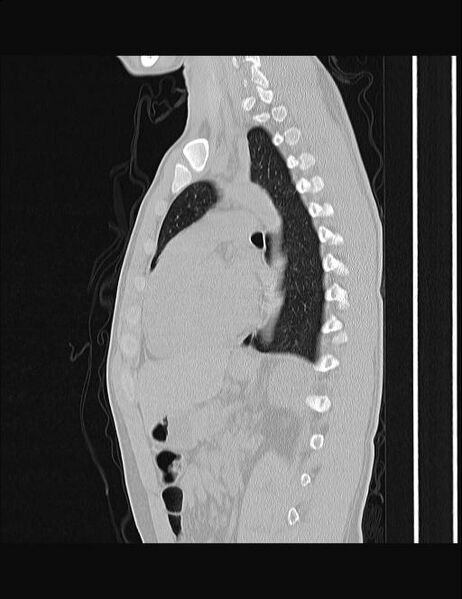 File:Calcifying pulmonary metastases (Radiopaedia 33359-34396 Sagittal lung window 29).jpg
