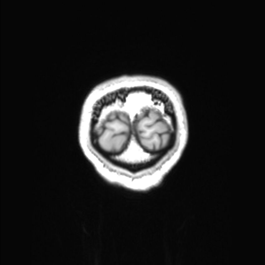 Callosal dysgenesis with interhemispheric cyst (Radiopaedia 53355-59335 Coronal T1 6).jpg