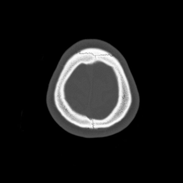 File:Calvarial osteoma (Radiopaedia 36520-38079 Axial bone window 100).jpg