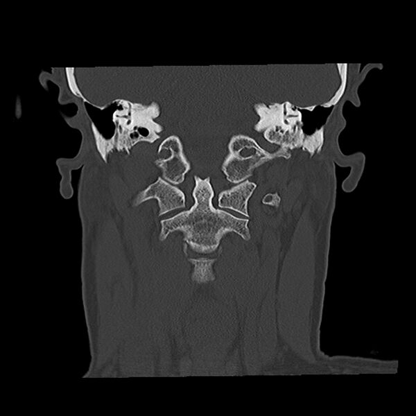 File:Canal up mastoidectomy (Radiopaedia 78108-90638 Coronal bone window 37).jpg
