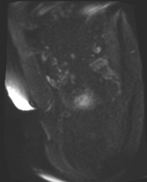 File:Cancer cervix - stage IIb (Radiopaedia 75411-86615 Sagittal DWI 67).jpg