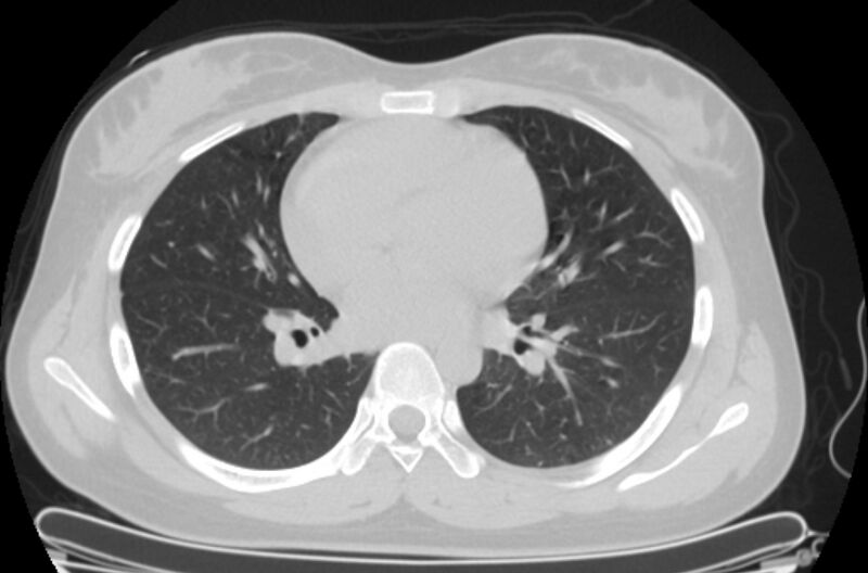 File:Cannonball metastases - uterine choriocarcinoma (Radiopaedia 70137-80173 Axial lung window 55).jpg