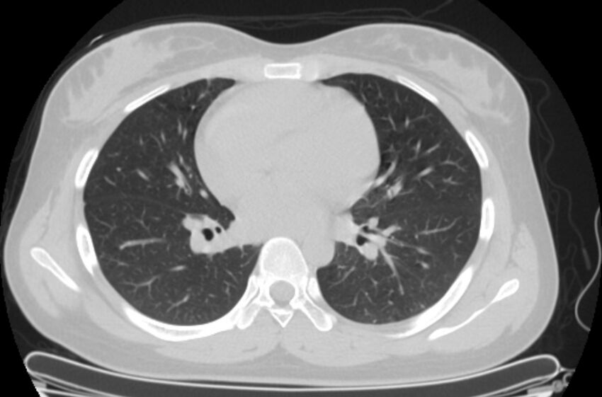 Cannonball metastases - uterine choriocarcinoma (Radiopaedia 70137-80173 Axial lung window 55).jpg
