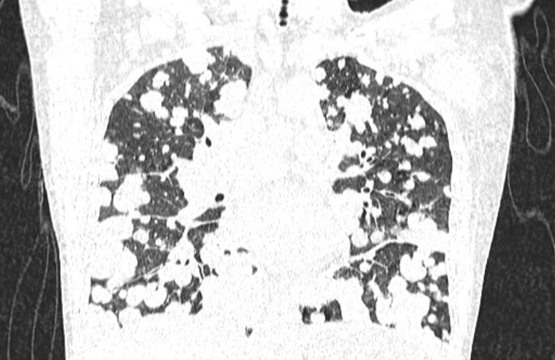 File:Cannonball metastases from breast cancer (Radiopaedia 91024-108569 Coronal lung window 72).jpg