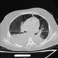 Cardiogenic pulmonary edema (Radiopaedia 29213-29609 Axial lung window 43).jpg