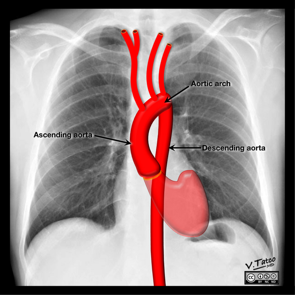 File:Cardiomediastinal anatomy on chest radiography (annotated images) (Radiopaedia 46331-50742 N 1).png